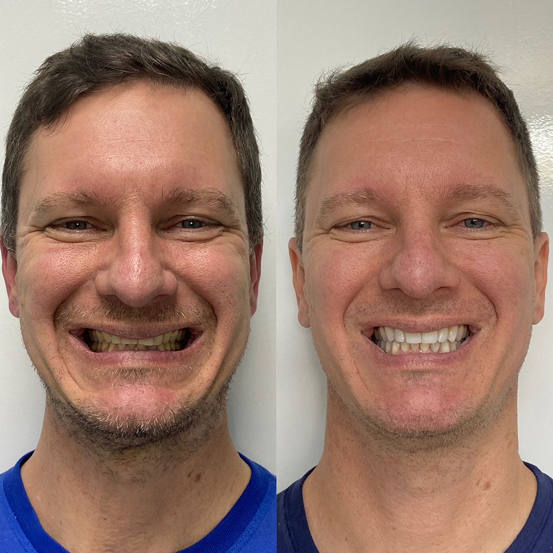 Antes e Depois Caso 01 — BCM Odontologia