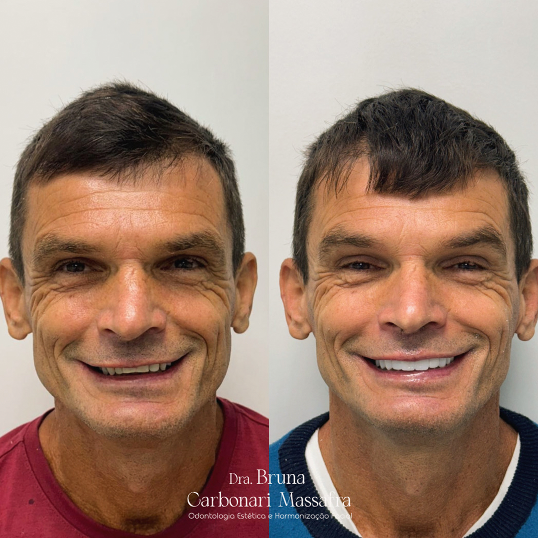 Antes e Depois Caso 02 — BCM Odontologia