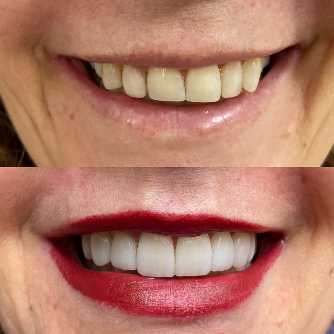 Antes e Depois Caso 03 — BCM Odontologia